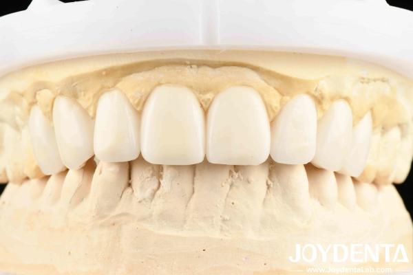 Dental's Good Elasticity And Tooth Arrangement Technology Flexible Denture Finish In Dental Care