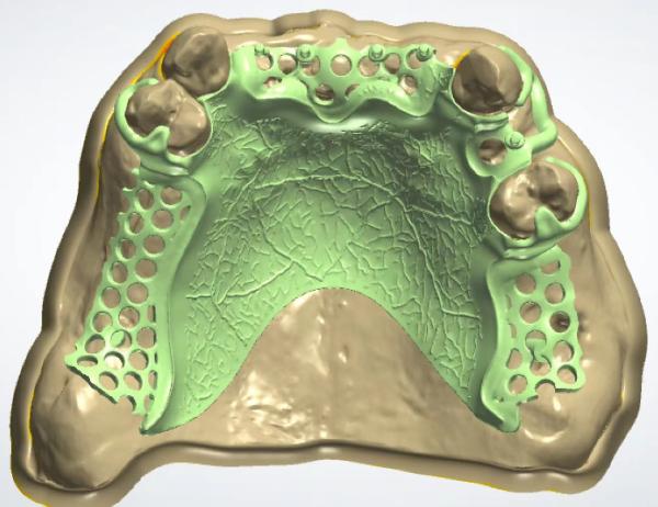 High Strength Casting Metal Partial Denture Cocr Aolly With 3D Printing