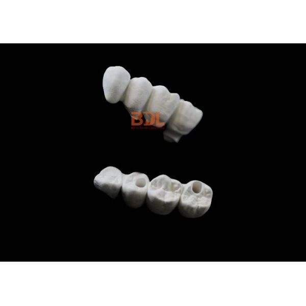 Low Thermal Conductivity All Ceramic Dentures High Fracture Toughness Cementation