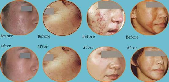 Машина красоты лазера многофункциональная, оборудование обработки лазера СО2 частичное