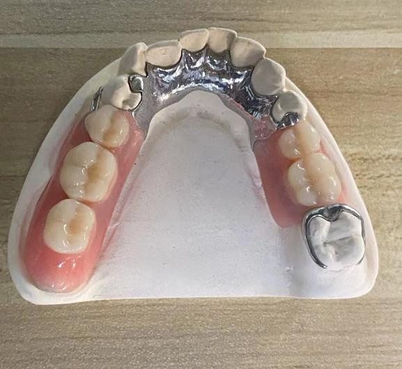 High Strength Casting Metal Partial Denture Cocr Aolly With 3D Printing