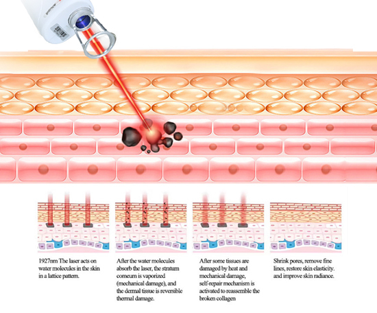 1927nm Fractional Thulium Laser Skin Rejuvenation Laser Machine 8W 15W 20W 30W