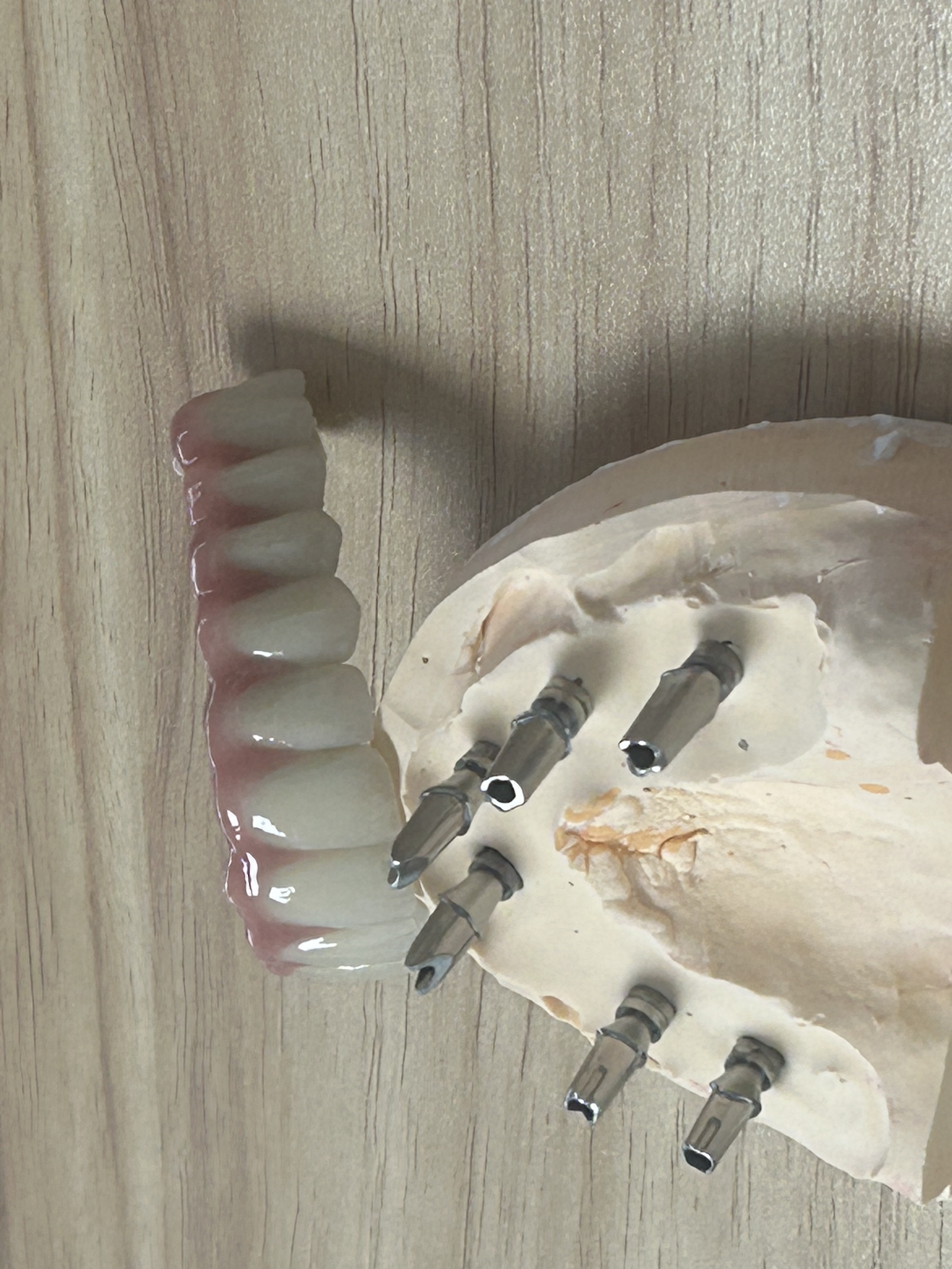 High-Strength Dental Zirconia Implant Crown with Natural Translucency & Tooth-Like Appearance via Digital CAD/CAM