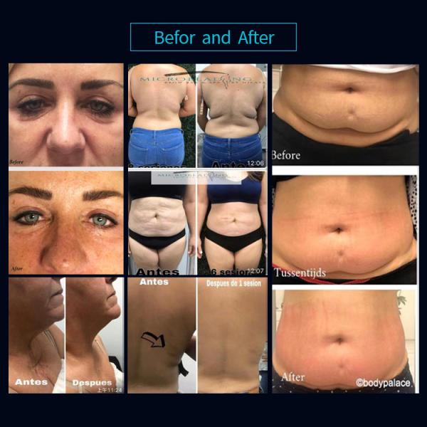Professional Therma Sculpt Vela Shape Machine Rf Vacuum Cavitation Butt Lifting