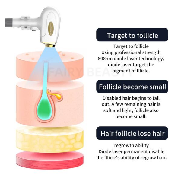удаление 808nm 1064nm волос лазера длины волны тройки 755nm