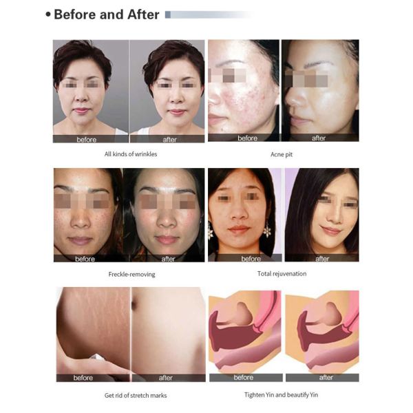 Fractional Co2 Laser Machine Pigment Removal Scar Removal Large Pores Treatment 110V-250V