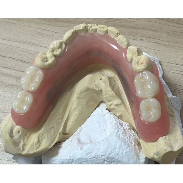 Removable Denture with Lingual Bar Retention for High Precision Fit and Conservative Tooth Preservation
