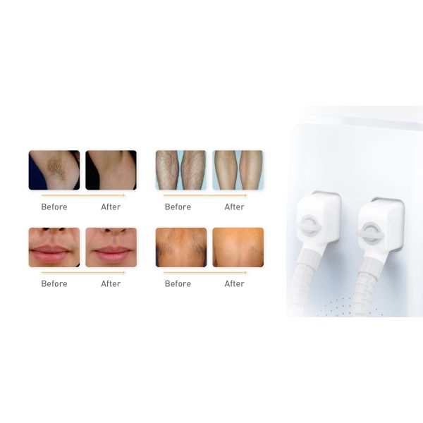 Двойная машина удаления волос лазера диода ручки 808nm