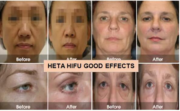 20000 патронов машины 8 подтяжки лица съемок 3Д Хифу не хирургических с 1-11 выравниваются