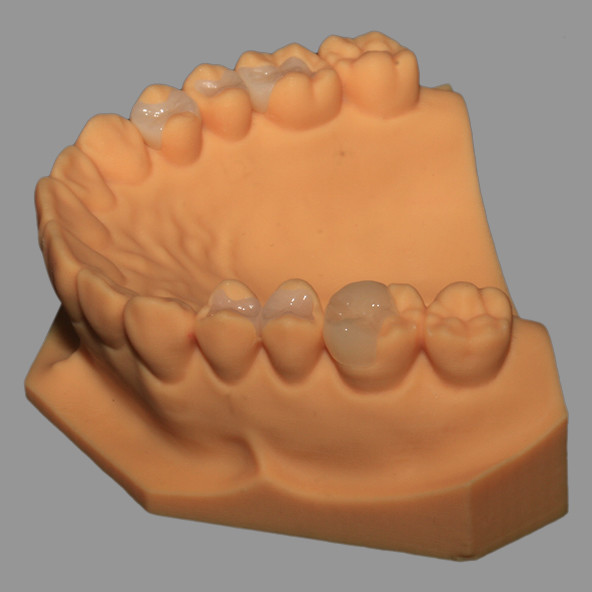 Full Ceramic Dental Emax Inlay Onlay Crown Pressed / Milled