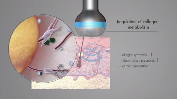 Salão de beleza Máquina de Tratamento de Ultrassonografia LDM Apertar a pele facial