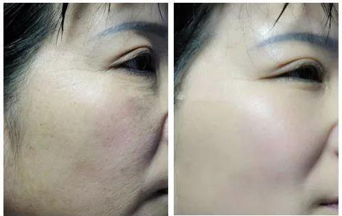 Сыворотка заполнителя Meso решения Hyamely 5ML Hyaluronic кисловочная дермальная