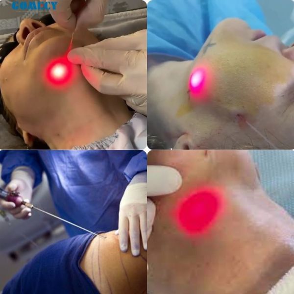 Portable 980NM 1470NM Diode Laser Double Wavelength Liposuction Device for Face Lifting and Dissolving Fat Professional