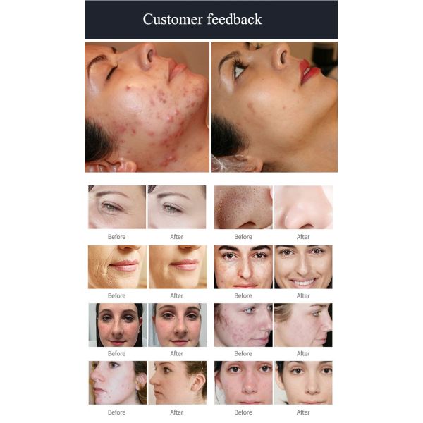 Hydra Oixgen Facial Machine Skin Analyzer Face Cleansing Beauty Machine