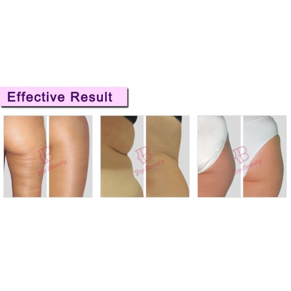 Терапевтическая машина Салон красоты Вакуумная система Роликовый массаж Анти целлюлит Вакуумная роликовая машина