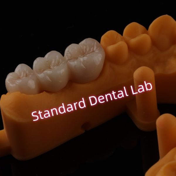 Puente de cerámica de porcelana de zircón de PFZ de alta transparencia en capas