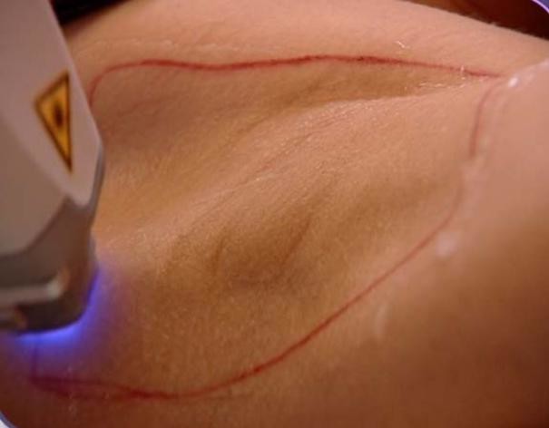 прибор удаления волос лазера диода 10Hz