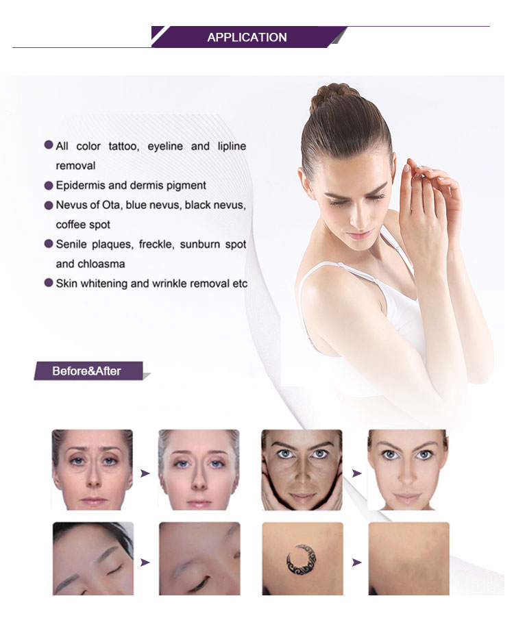 1064nm Q Switched Nd Yag Laser For Tattoo Removal Eliminate Pigment / Skin Rejuvenation