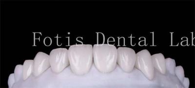 Polishing Finishing Cosmetic Teeth Veneer Covers  For Beautiful Smile