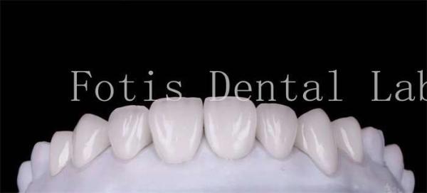 Polishing Finishing Cosmetic Teeth Veneer Covers  For Beautiful Smile