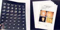 Materiales médicos Impresión con láser Película blanca opaca Película médica de rayos X Imagen de impresión Película para impresora de inyección de tinta Epson & Canon
