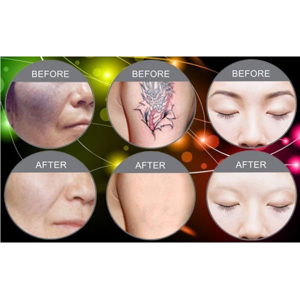 Multifunctional IPL Beauty Machine Hair Removal Acne Treatment Machine