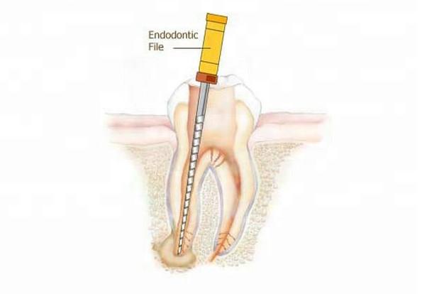 Localizador dental do vértice de Niti Endo Rotary Files Barbed Broaches do motor
