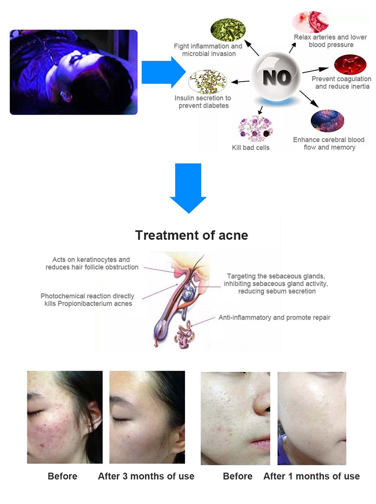 Кровати терапией света СИД PBM машина красной фотодинамическая для обработки усталости