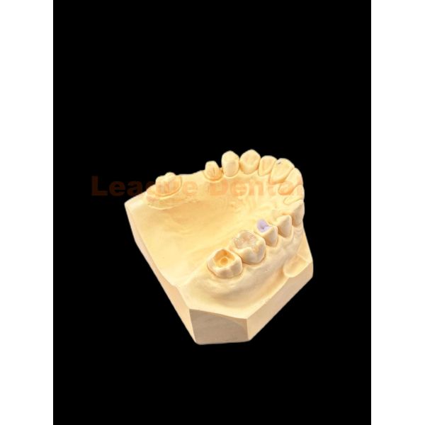 Natural Looking E.MAX Inlay Onlay Lithium Disilicate Inlay Onlay