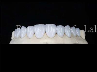 Customized Natural Porcelain Veneers Dental Lab Veneers Stain Resistant