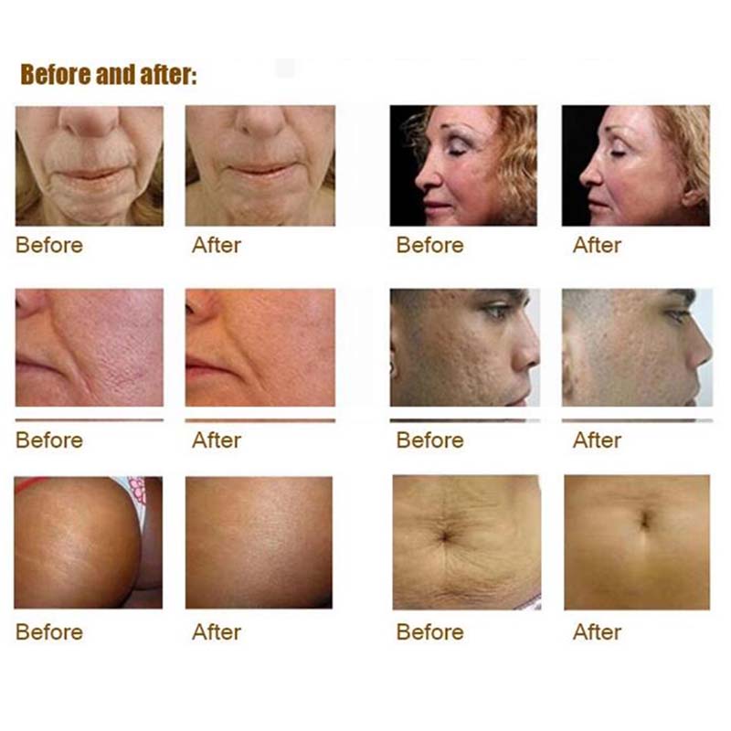 Подниматься стороны машины Rf Microneedle подмолаживания кожи частичный