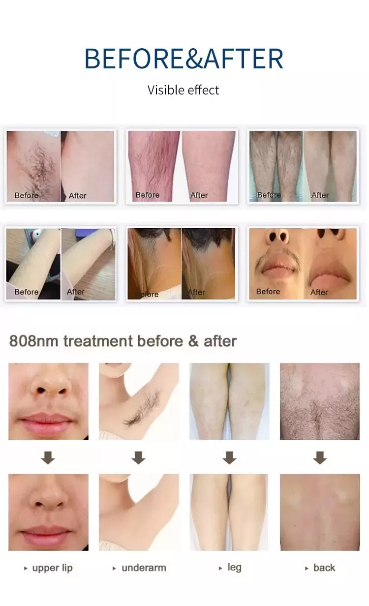 Portable 2 In 1 808 Diode Laser Hair Removal Machine Multifunction Ce