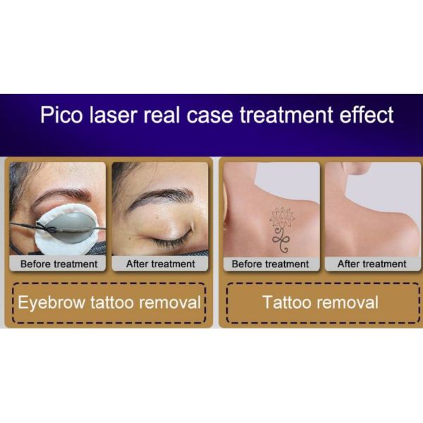 810 нм Депилатор Титановый Диод Лазерная Машина Красоты 3 Волны Удаление волос Пико Лазерная Удаление Татуировки