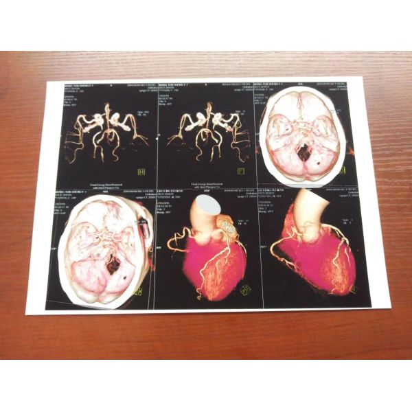 Основанный ЛЮБИМЦЕМ OEM фильма медицинского сухого фильма белый струйный x Рэй 125um 150um 180um