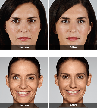 Заполнители Skinject 5ml глубокие Hyaluronic кисловочные лицевые сморщивают удаление