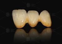 A3 A3.5 Porcelana fundida a metal e coroa dental cerâmica