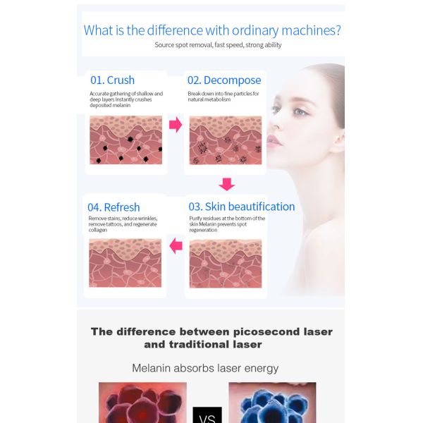 La peau Pico Carbon Facial Laser Machine tatouent le retrait 1064nm 532nm 1320nm