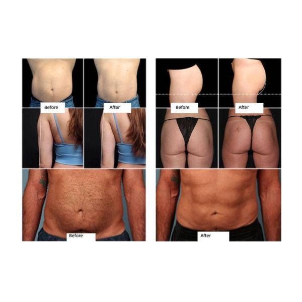 Portable Weight Loss Ems Body Sculpting Machine Rf Neo Mini