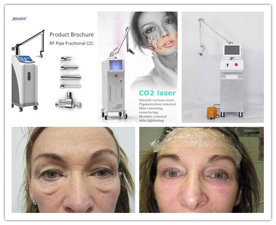 2015 Newest and Best fractional co2 laser/co2 fractional laser vaginal tightening