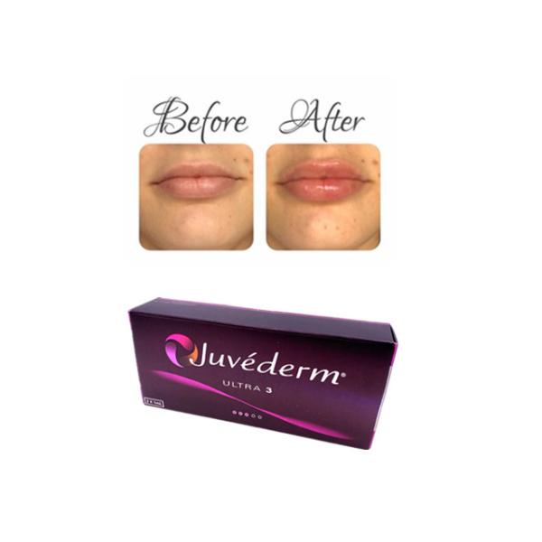 Aumento ácido hialurónico Derma do enchimento do bordo de Juvederm ultra 4 Voluma