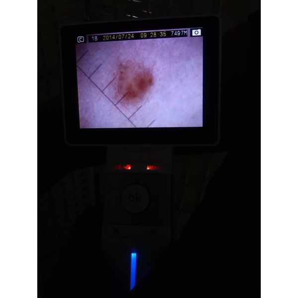 Dérmatoscope vidéo numérique 1920x1080