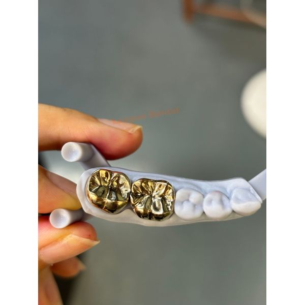 Accurate Alloy Full Cast Dental Crown For Precise Fit And Durability
