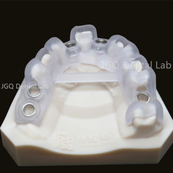 Digital Tooth Supported Surgical Guide For Dental Implants 3D Printed