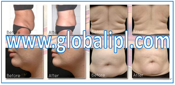 1200W Power Non Surgical Liposuction Machine With Vacuum Cavitation System