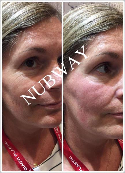Best effect!!! fat freeze,skin rejuvenation,wrinkle removal cryolipolysis slimming machine